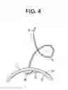 Fig. 04 - Method and Devices for a Sub-Splenius/Supra-Levator Scapulae Surgical Access Technique