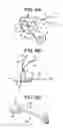 Fig. 07 - Method and Devices for a Sub-Splenius/Supra-Levator Scapulae Surgical Access Technique