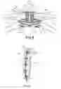 Fig. 06 - Split sternum prosthesis