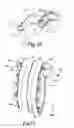 Fig. 08 - Split sternum prosthesis