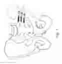 Fig. 02 - Method and apparatus for sacroiliac joint fixation