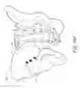 Fig. 22 - Method and apparatus for sacroiliac joint fixation