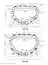 Fig. 02 - HEART AND PERIPHERAL VASCULAR VALVE REPLACEMENT IN CONJUNCTION WITH A SUPPORT RING