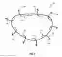 Fig. 12 - HEART AND PERIPHERAL VASCULAR VALVE REPLACEMENT IN CONJUNCTION WITH A SUPPORT RING