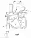 Fig. 13 - HEART AND PERIPHERAL VASCULAR VALVE REPLACEMENT IN CONJUNCTION WITH A SUPPORT RING