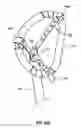Fig. 25 - HEART AND PERIPHERAL VASCULAR VALVE REPLACEMENT IN CONJUNCTION WITH A SUPPORT RING
