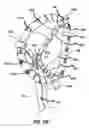 Fig. 28 - HEART AND PERIPHERAL VASCULAR VALVE REPLACEMENT IN CONJUNCTION WITH A SUPPORT RING