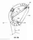 Fig. 30 - HEART AND PERIPHERAL VASCULAR VALVE REPLACEMENT IN CONJUNCTION WITH A SUPPORT RING