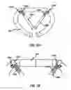 Fig. 33 - HEART AND PERIPHERAL VASCULAR VALVE REPLACEMENT IN CONJUNCTION WITH A SUPPORT RING