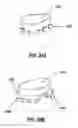Fig. 52 - HEART AND PERIPHERAL VASCULAR VALVE REPLACEMENT IN CONJUNCTION WITH A SUPPORT RING