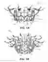 Fig. 02 - Prosthetic valve with inflatable cuff configured to fill a volume between atrial and ventricular tissue anchors
