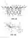 Fig. 06 - Prosthetic valve with inflatable cuff configured to fill a volume between atrial and ventricular tissue anchors