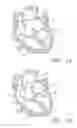 Fig. 02 - Prosthetic tissue valves and methods for replacing native atrioventricular valves with same