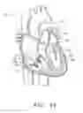 Fig. 35 - Prosthetic tissue valves and methods for replacing native atrioventricular valves with same