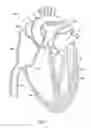 Fig. 02 - Percutaneous repair of mitral prolapse