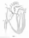 Fig. 08 - Percutaneous repair of mitral prolapse