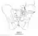 Fig. 02 - Systems for and methods of preparing and fusing a sacroiliac joint