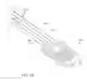 Fig. 16 - Systems for and methods of preparing and fusing a sacroiliac joint