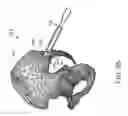 Fig. 65 - Systems for and methods of preparing and fusing a sacroiliac joint