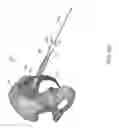 Fig. 68 - Systems for and methods of preparing and fusing a sacroiliac joint