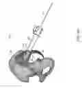 Fig. 69 - Systems for and methods of preparing and fusing a sacroiliac joint