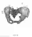 Fig. 70 - Systems for and methods of preparing and fusing a sacroiliac joint