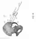 Fig. 72 - Systems for and methods of preparing and fusing a sacroiliac joint