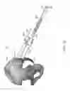 Fig. 75 - Systems for and methods of preparing and fusing a sacroiliac joint