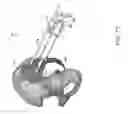Fig. 77 - Systems for and methods of preparing and fusing a sacroiliac joint