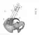 Fig. 79 - Systems for and methods of preparing and fusing a sacroiliac joint