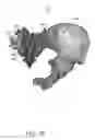 Fig. 80 - Systems for and methods of preparing and fusing a sacroiliac joint
