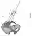 Fig. 83 - Systems for and methods of preparing and fusing a sacroiliac joint