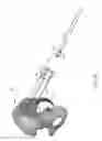 Fig. 92 - Systems for and methods of preparing and fusing a sacroiliac joint