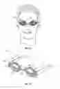 Fig. 02 - Eyelid treatment device and associated methods