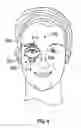 Fig. 05 - Eyelid treatment device and associated methods
