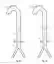 Fig. 16 - Intra-aortic balloon apparatus, assist devices and methods for improving flow, counterpulsation and haemodynamics