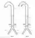 Fig. 22 - Intra-aortic balloon apparatus, assist devices and methods for improving flow, counterpulsation and haemodynamics