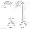 Fig. 33 - Intra-aortic balloon apparatus, assist devices and methods for improving flow, counterpulsation and haemodynamics
