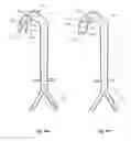 Fig. 34 - Intra-aortic balloon apparatus, assist devices and methods for improving flow, counterpulsation and haemodynamics