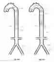 Fig. 35 - Intra-aortic balloon apparatus, assist devices and methods for improving flow, counterpulsation and haemodynamics