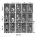 Fig. 09 - Enhanced cancer immunotherapy by microneedle patch-assisted delivery