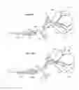 Fig. 40 - Device and methods for transvascular tumor embolization