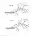 Fig. 41 - Device and methods for transvascular tumor embolization