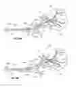 Fig. 44 - Device and methods for transvascular tumor embolization