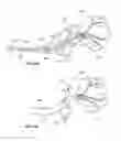 Fig. 45 - Device and methods for transvascular tumor embolization