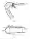 Fig. 02 - Perfusion catheters and related methods