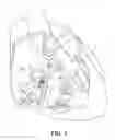 Fig. 02 - Electrodes for intra-cardiac pacemaker