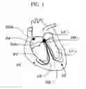 Fig. 02 - Subsurface electrodes for electric field shaping with wrapping supporting structures