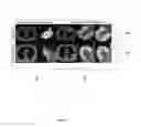 Fig. 07 - Predicting recurrence in early stage non-small cell lung cancer (NSCLC) with integrated radiomic and pathomic features