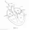 Fig. 02 - Devices and methods for heart valve repair